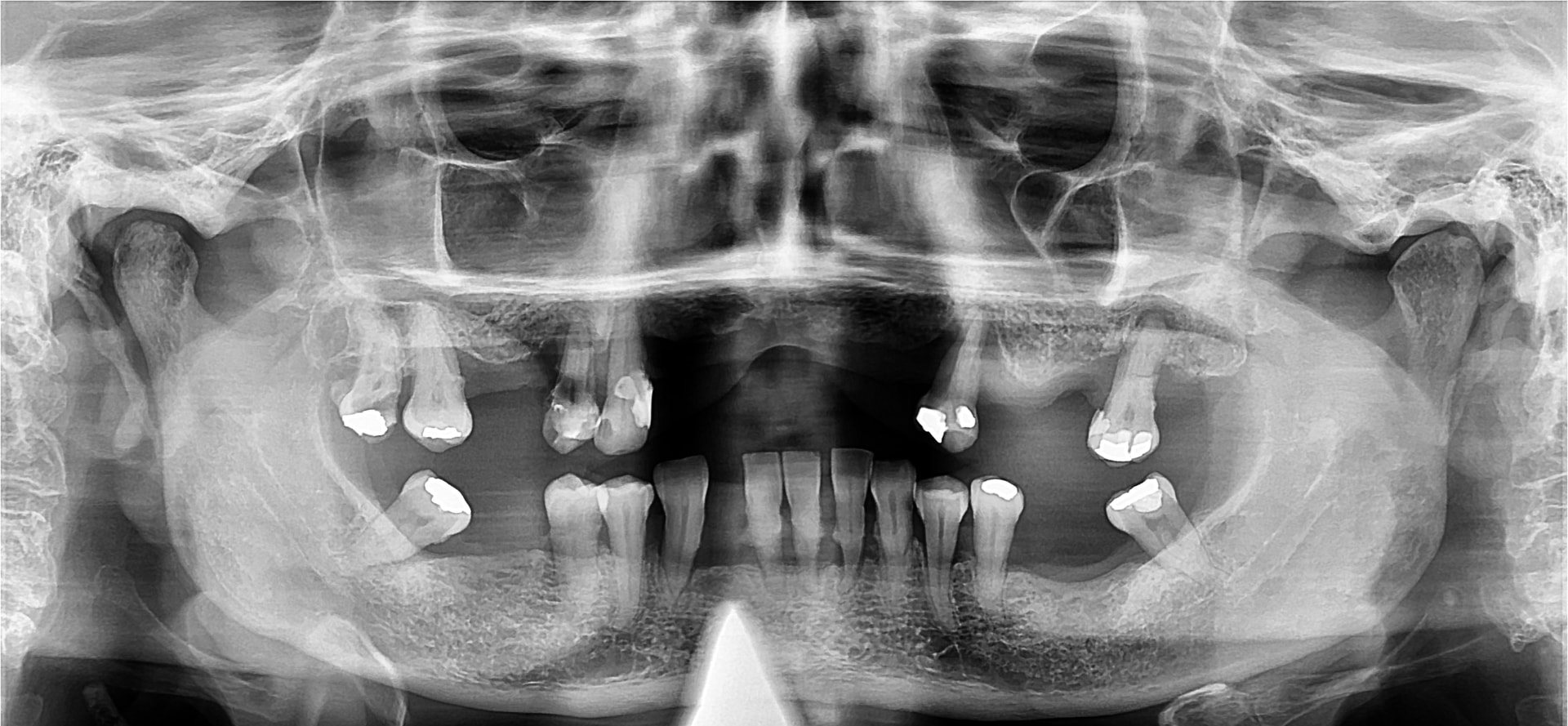 Radiografia panorâmica antes, Maria