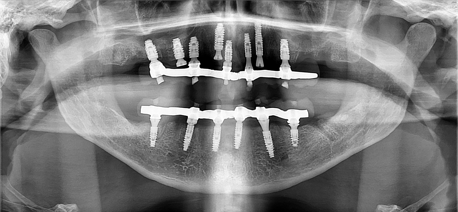 Radiografia panorâmica depois, Celso