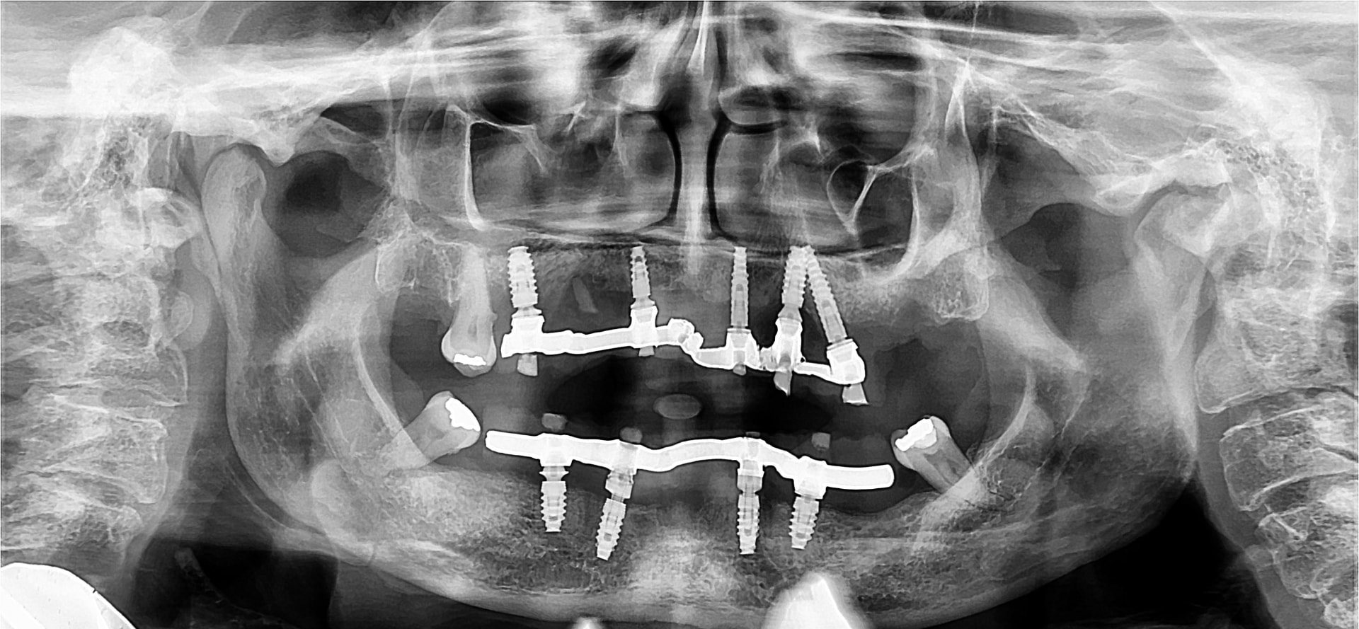 Radiografia panorâmica depois, Maria