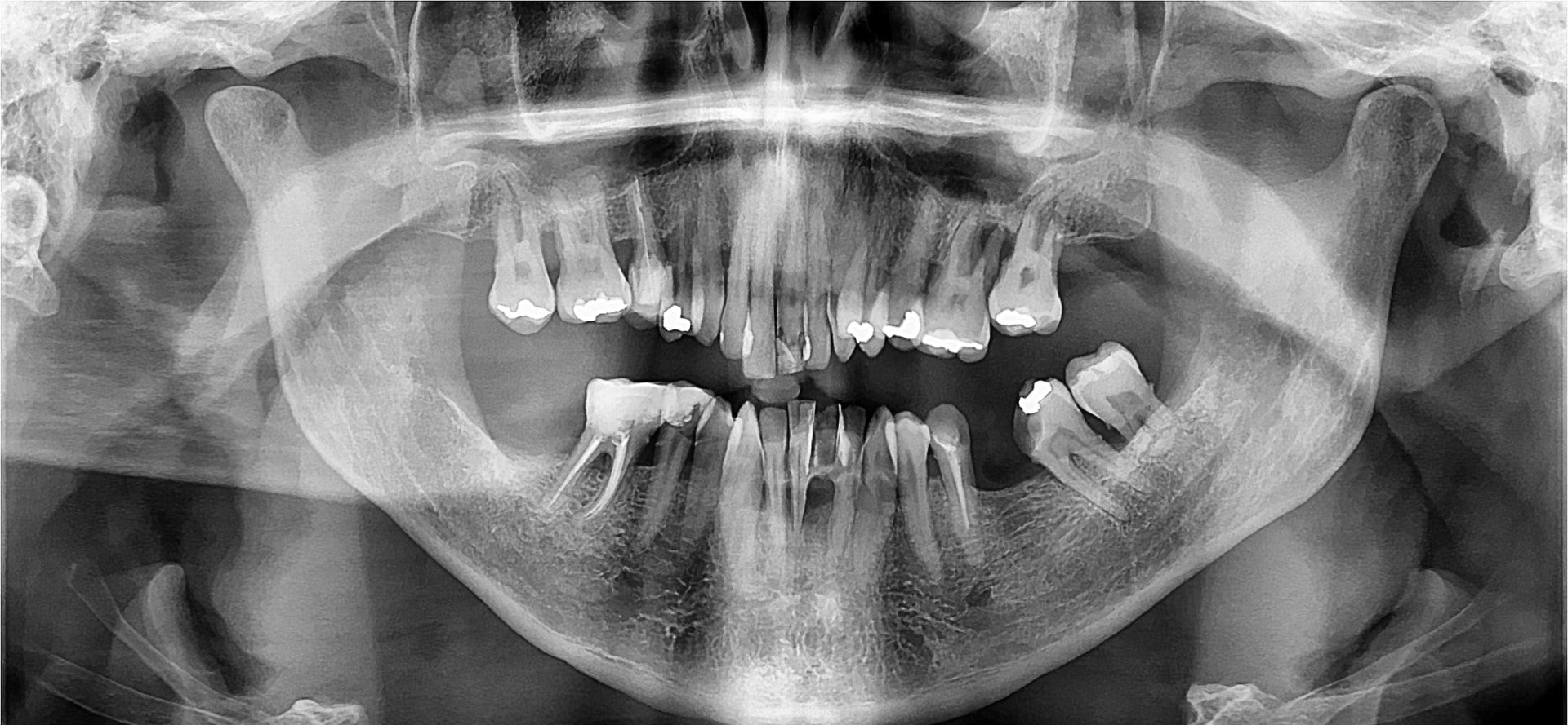 Radiografia panorâmica antes, Celso