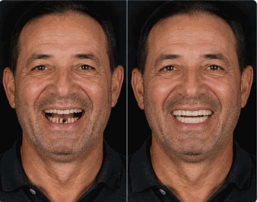 Clinical case LOWER ARCH PROTOCOLO